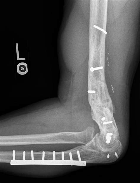 Infected Nonunion: Elbow Case 1 - Dr. Mark Brinker, Houston Orthopedic