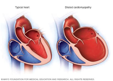 Dilated Cardiomyopathy Mayo Clinic