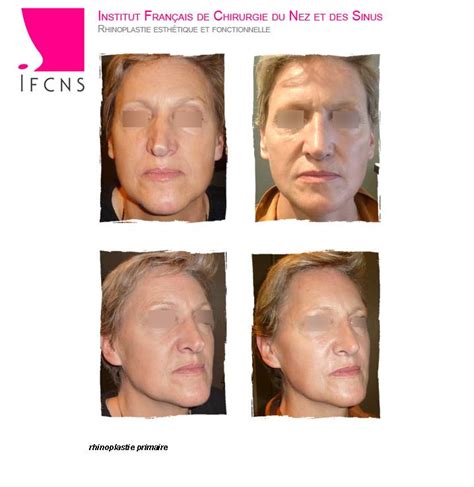 Rhinoplastie avant et après opération à Paris Institut Rhinoplastie