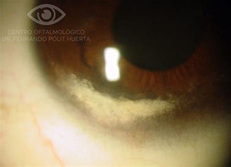 Degeneración lipídica corneal Atlas de Oftalmología