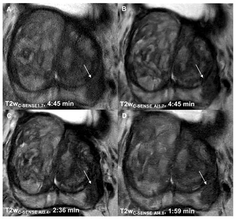 Cancers Free Full Text Prospectively Accelerated T2 Weighted