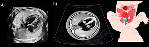 Ultrasound Evaluation Of The Fetal Thorax Article Glowm