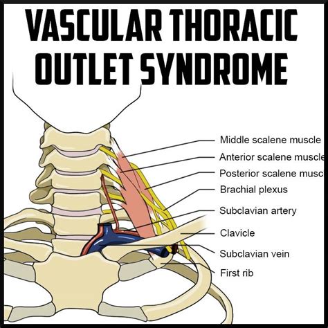 Thoracic Outlet Syndrome Anatomy