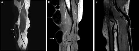 VISTA images of AVFs in two dialysis patients. a: Significant ...