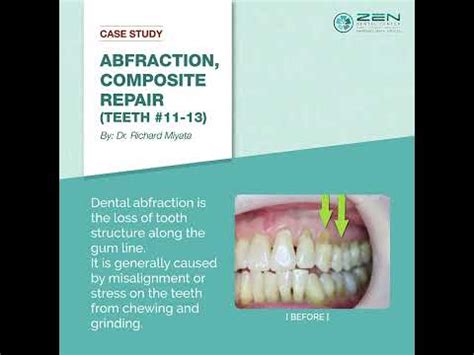 Zen Dental Case Study Abfraction Composite Repair Teeth 11 13