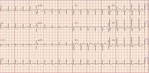 EKG On Admission Shows Sinus Tachycardia Otherwise Normal Rhythm With