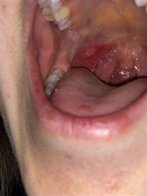 Canker Sore In Throat