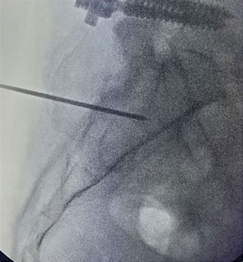 Sacroiliac Joint Posterior Fusion Anesthesia Key