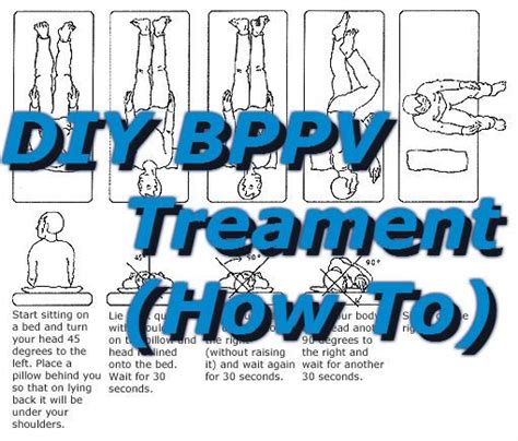 Do It Yourself Epley Maneuver - pacificbap