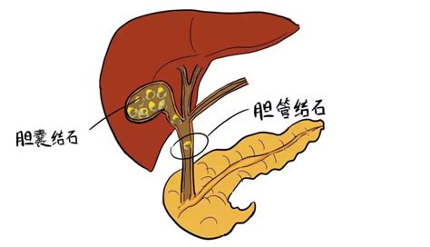 什么是胆囊结石？如何预防胆囊结石？看完这篇文章你就明白了腾讯新闻