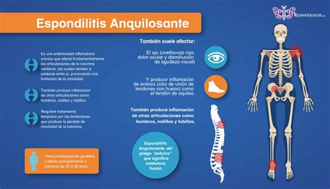 Qu Es La Espondilitis Anquilosante Reum Tologos Mx