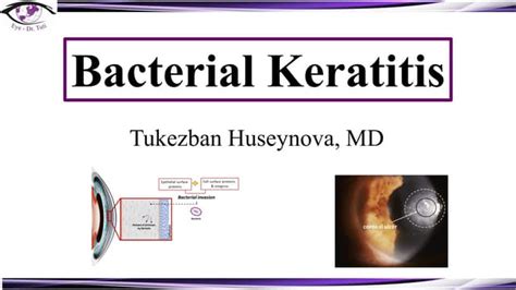 Bacterial Keratitis Ppt