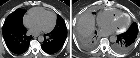 Fulminant Giant Cell Myocarditis Induced Myocardial Calcification