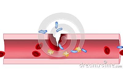 Sepsis Close Up Of Cross Section Of Blood Vessel With Bacterial