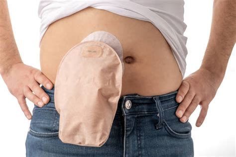 730 Colostomy Stock Photos Pictures And Royalty Free Images Istock