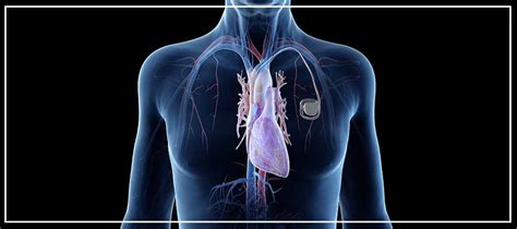 Permanent Pacemaker Implantation Near Me in Downey, CA