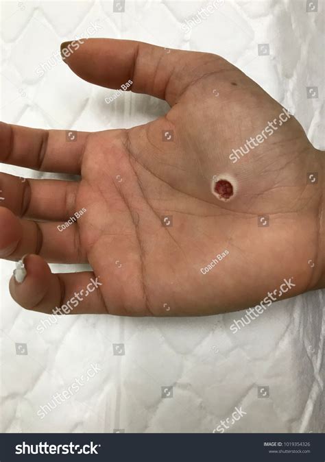 Hpv On Hands