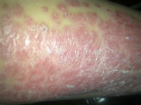 Psoriasis Rash Pictures Symptoms