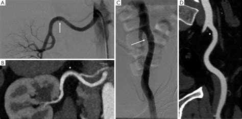 Figure 1 From Catheter Based Angiography Versus CT Angiography For The