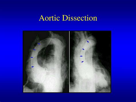 Ppt Aortic Insufficiency Acute And Chronic Powerpoint Presentation Free Download Id 4230992