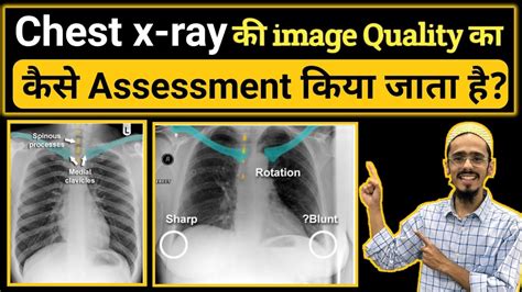 How To Read Chest X Ray Chest X Ray Kaise Dekhe Chest X Ray Chest X Ray Interpretation