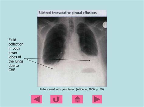 Ppt Pleural Effusions Powerpoint Presentation Free Download Id 224571