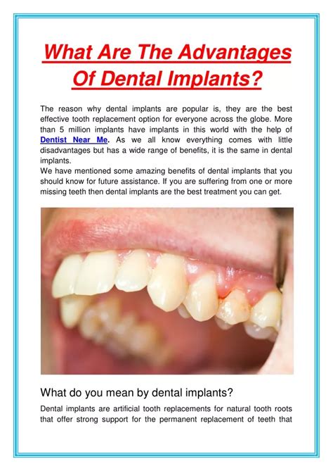 PPT What Are The Advantages Of Dental Implants PowerPoint