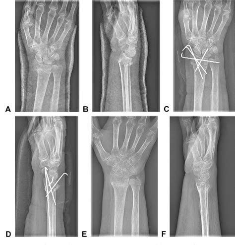 Distal Radius Fracture Kapandji Intrafocal Pinning Technique