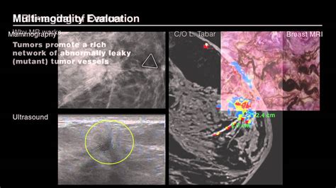 Breast Magnetic Resonance Imaging What When Why Youtube