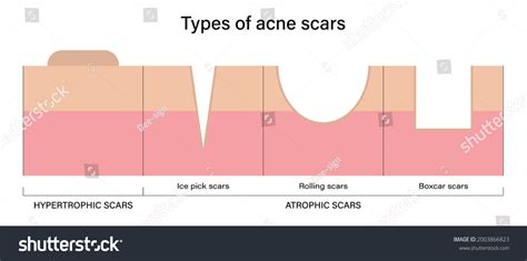 Types Acne Scars Vector Acne Scar Stock Vector Royalty Free