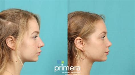 Rhinoplasty Before And After Pictures Case 702 Orlando And Tampa Florida Primera Plastic Surgery