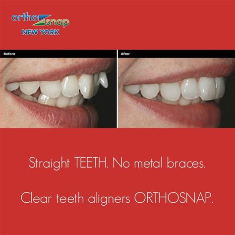 Orthosnap New York Straighten Teeth Without Braces