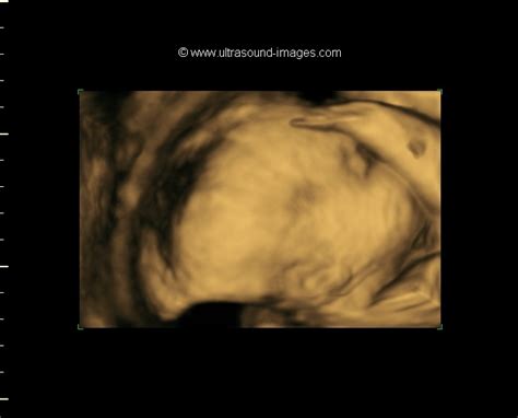 A Gallery of High-Resolution, Ultrasound, Color Doppler & 3D Images ...