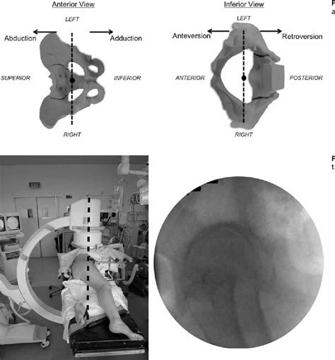 Figure From A Novel Fluoroscopic Approach To Assessing Patient