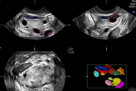 Ultrassonografia Transvaginal em Brasília Bonvena Medicina Reprodutiva