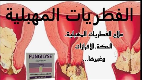 التخلص من الافرازات المهبلية والحكة والرائحة الكريهة بتحاميل Fungilyse