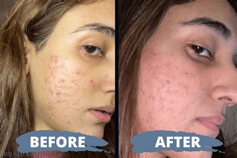 Microneedling Before And After Pro Needling