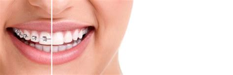 Maintain Your Orthodontic Results Newwave Orthodontics