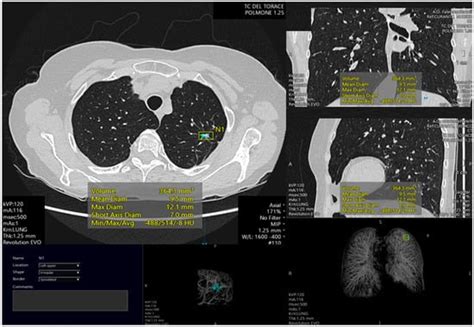 Cancers Free Full Text Artificial Intelligence In Lung Cancer