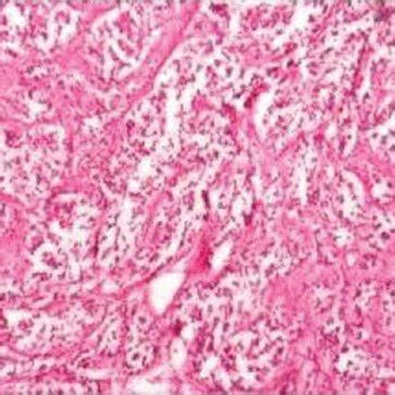 Paraganglioma histology (H&E, ×100) | Download Scientific Diagram