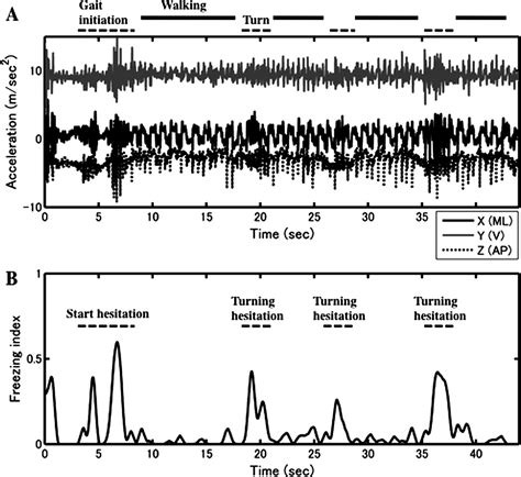 Practical Approach To Freezing Of Gait In Parkinson S Disease Practical Neurology