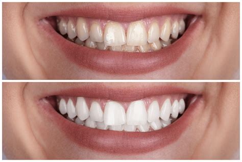 11 Ideal At Home Teeth Whitening Packages Of 2024 According To Dentists