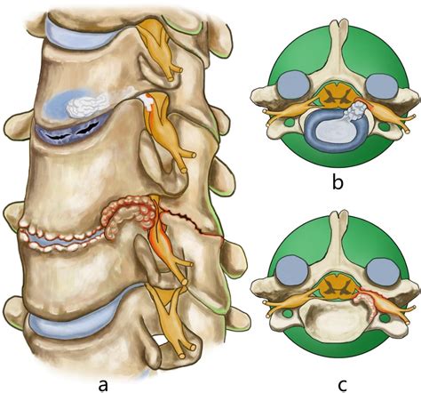 Figure 1 From Ultrasonic Osteotome Assisted Posterior Endoscopic