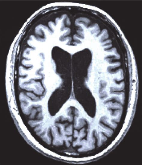 MRI scan showing atrophy of the brain in Huntington’s Disease (courtesy ...