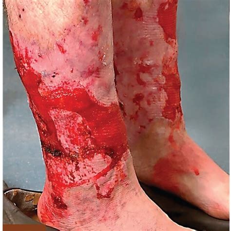 Bilateral Erythematous Plaques With Hemorrhagic And Erosive Lesions On