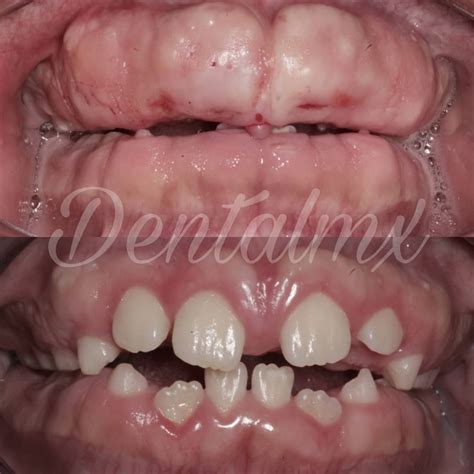 La Hipertricosis O El Síndrome Dentalmx Clinica Dental
