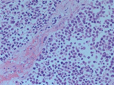 Histology demonstrating embryonal rhabdomyosarcoma with relatively... | Download Scientific Diagram