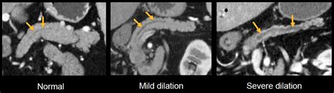 Abdominal CT: Biliary system and Pancreas • LITFL • Radiology