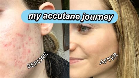 MY ACCUTANE JOURNEY Acne Side Effects Results Tips Skincare