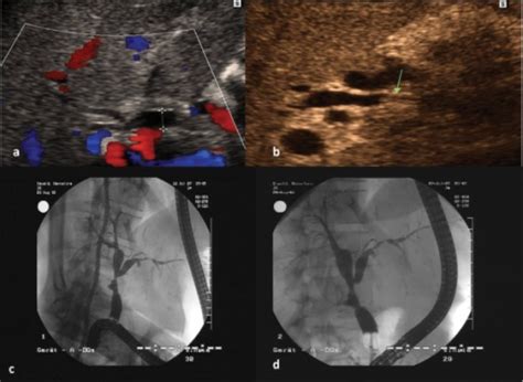 Biliary Reconstruction In Pediatric Liver Transplantation « Omics Journals